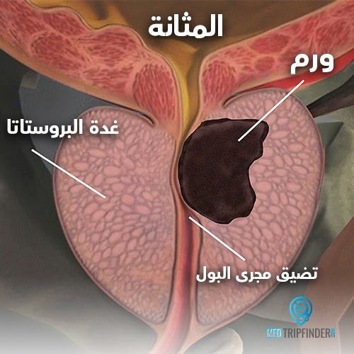 شكل سرطان البروستاتا